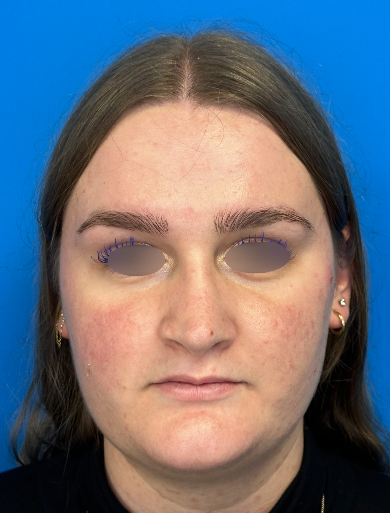Cas n° 8 Post-op face