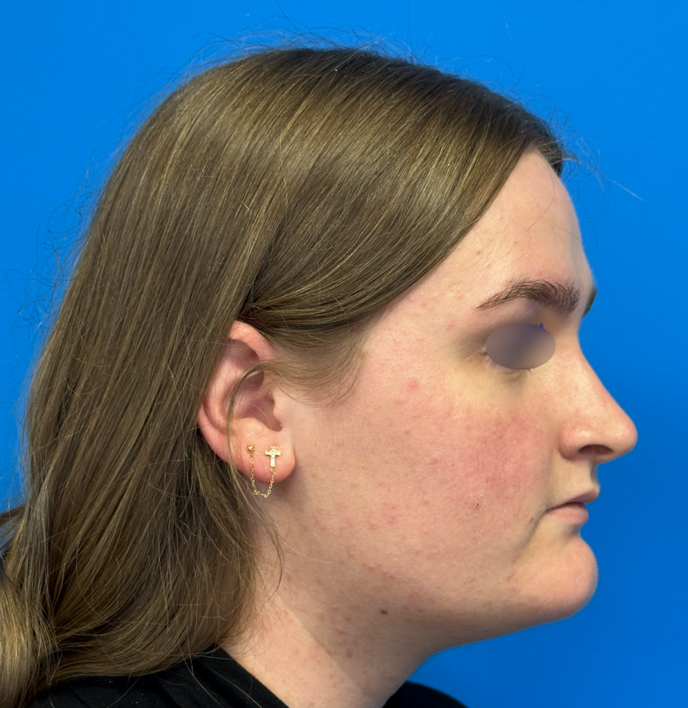 Cas n° 8 Post-op profil