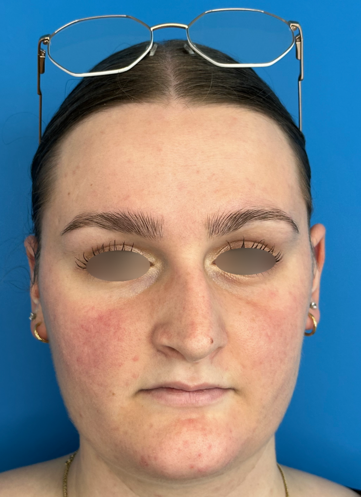 Cas n° 8 Pré-op face